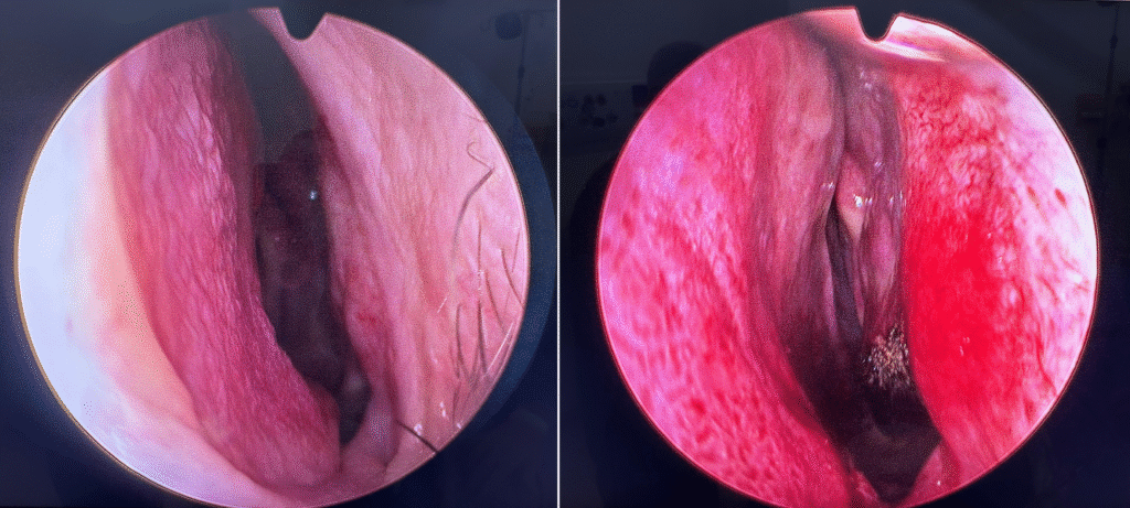 Septoplastia antes e depois, técnica endoscópica (associada a turbinectomia)